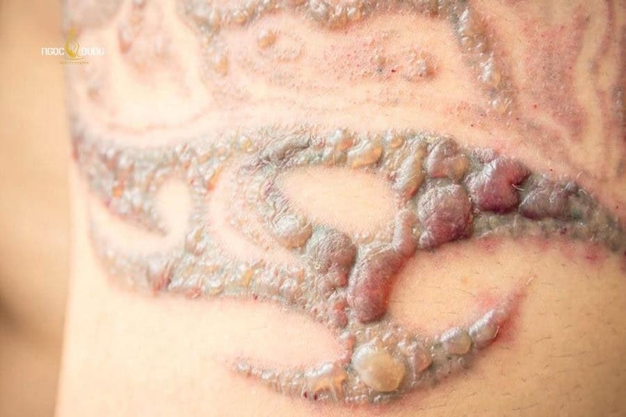 Mài da dễ để gây ra nguy cơ nhiễm trùng nếu thực hiện không đúng kỹ thuật