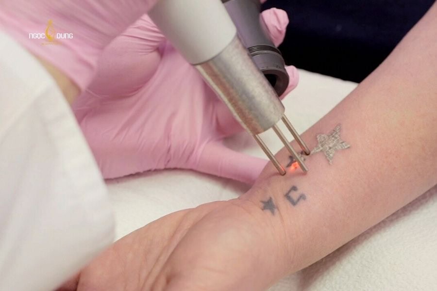 Các tông màu tối hấp thụ bước sóng laser tốt nhất nên dễ phá hủy hơn