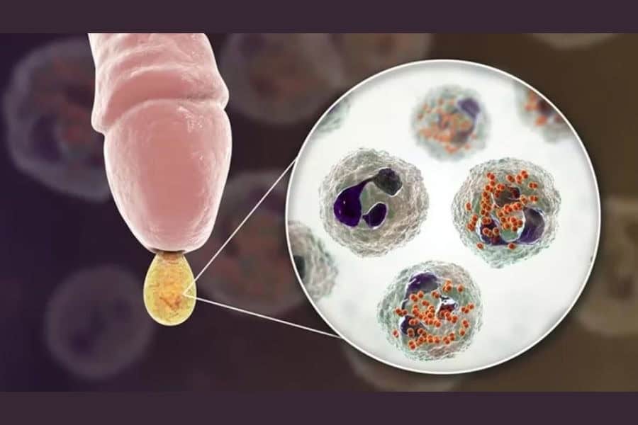 Nấm Candida là tác nhân phổ biến gây nổi mẩn đỏ hồng và ngứa ngáy âm ỉ tại vùng kín nam giới