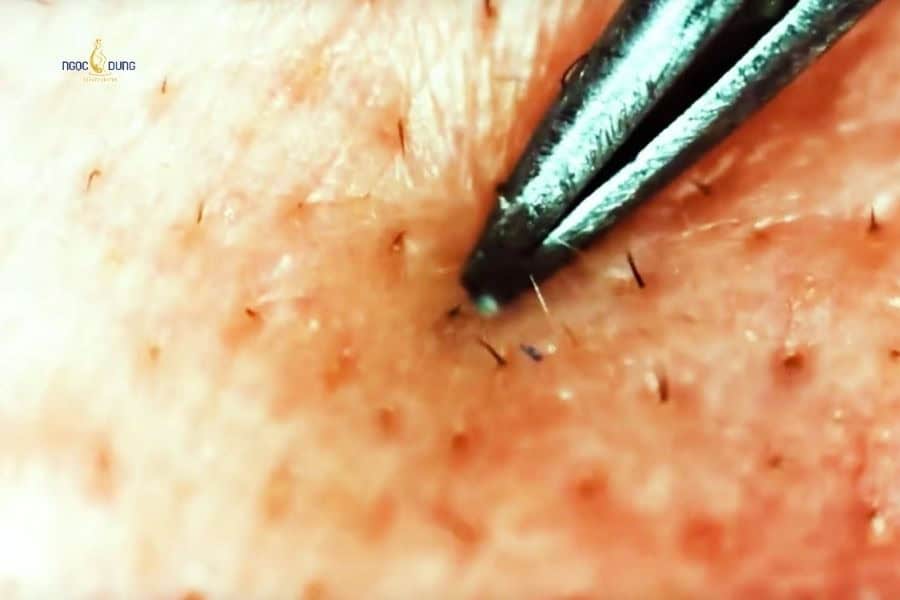 Nhổ lông mọc ngược ở nách chỉ nên thực hiện khi chưa đau nhiều