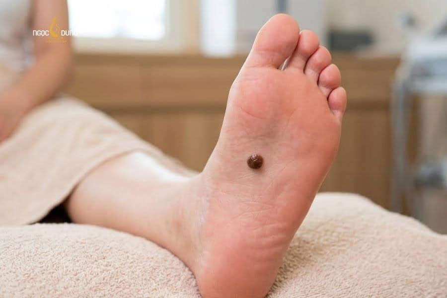 Giải mã ý nghĩa nốt ruồi lòng bàn chân nam nữ: Tốt xấu? 11 Nốt ruồi càng to và càng bóng ở lòng bàn chân thì người sở hữu càng gặp vận may về tài chính
