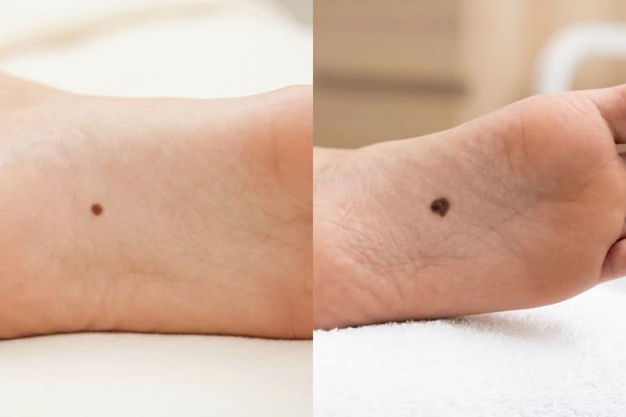 Giải mã ý nghĩa nốt ruồi lòng bàn chân nam nữ: Tốt xấu? 14 Dấu hiệu nhận biết giữa nốt ruồi lành tính và cảnh báo ung thư hắc tố (Melanoma)