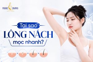 Tại sao lông nách mọc nhanh?