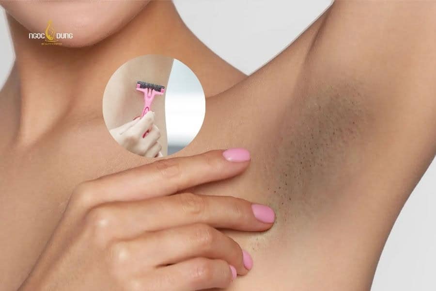 Vùng da dưới cánh tay có thể bị thâm do cạo sai kỹ thuật