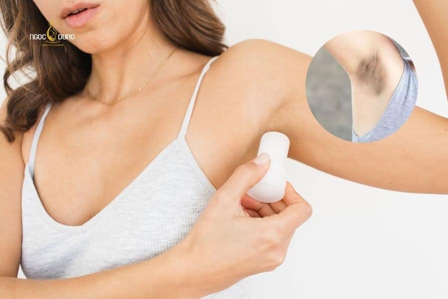 Triệt lông nách có hết thâm không? Cách xử lý hiệu quả 3 Dùng lăn khử mùi không phù hợp cũng sẽ gây ra tình trạng thâm nách