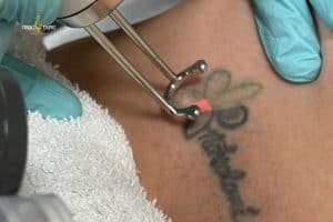 Xóa xăm là làm mờ hoặc loại bỏ mực xăm với công nghệ cao
