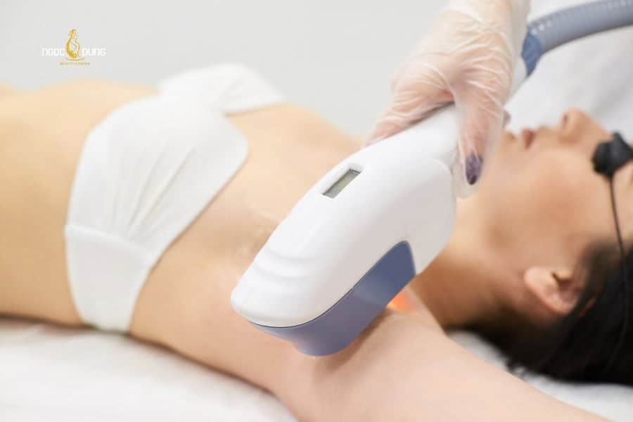 Bị hôi nách có nên cạo lông nách? Mẹo kiểm soát mùi hôi 5 Triệt lông công nghệ cao vừa giúp giảm tốc độ mọc lông vừa hỗ trợ giảm mùi hôi nách