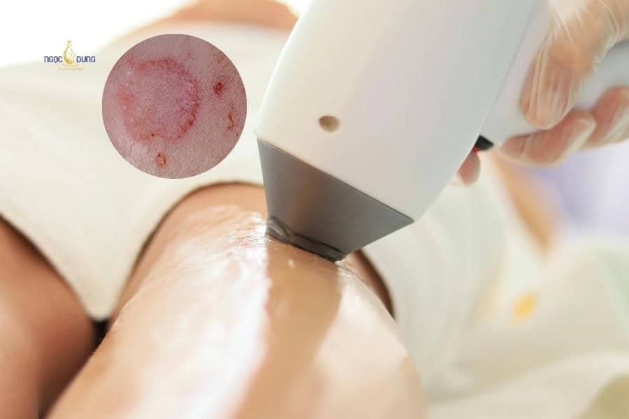 Đang có kinh có triệt lông được không? Lưu ý an toàn 3 Triệt lông khi đang có kinh nguyệt dễ gây tổn thương da