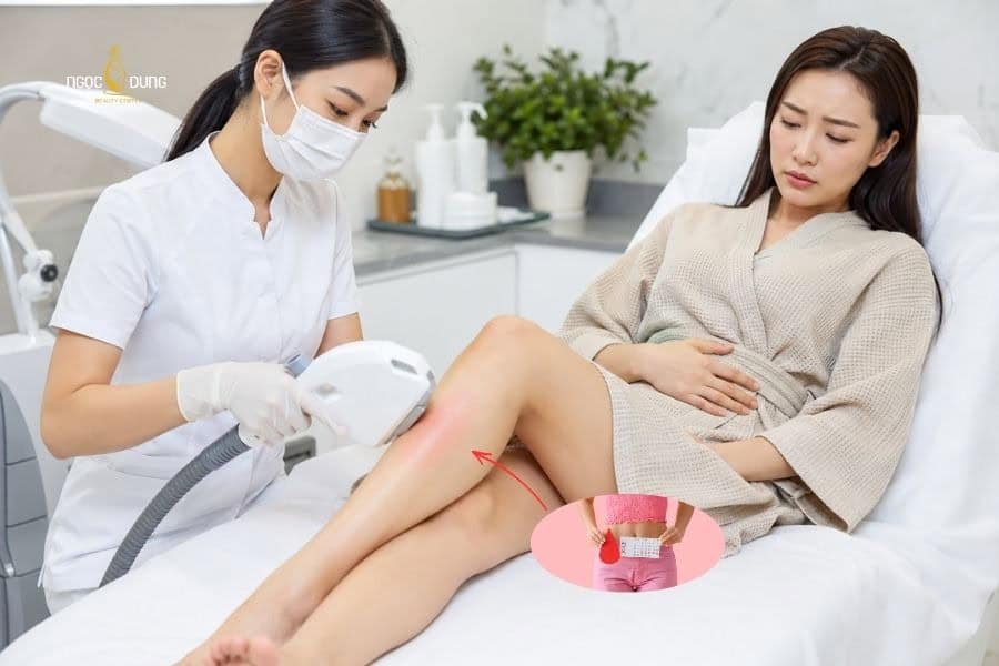 Đang có kinh có triệt lông được không? Lưu ý an toàn 5 Triệt lông khi đang ở chu kỳ dễ bị nhiễm trùng hơn
