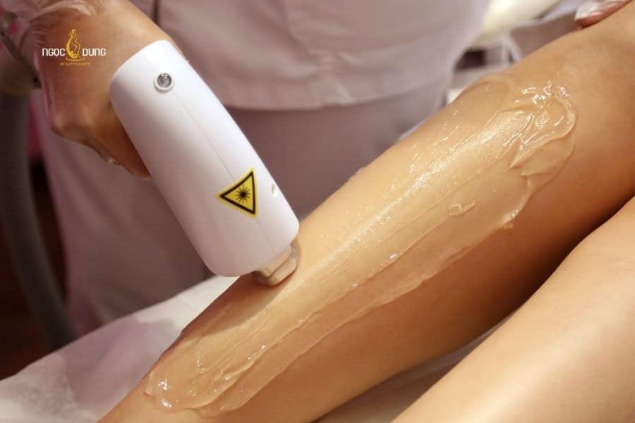 Triệt lông không thể cải thiện hoàn toàn trong một lần