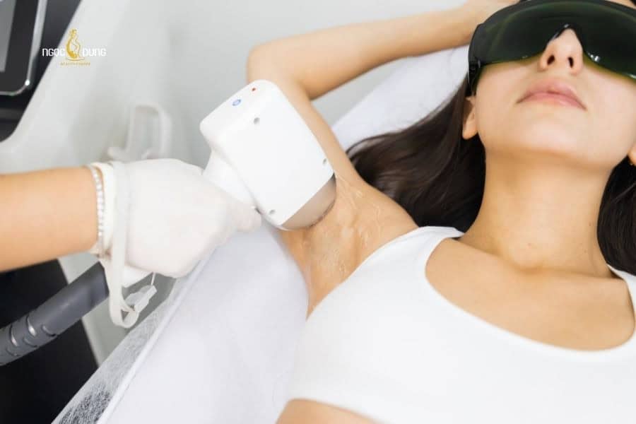 Triệt lông nách có hết thâm không? Cách xử lý hiệu quả 6 Triệt lông nách sẽ hỗ trợ giảm thâm vùng da dưới cánh tay