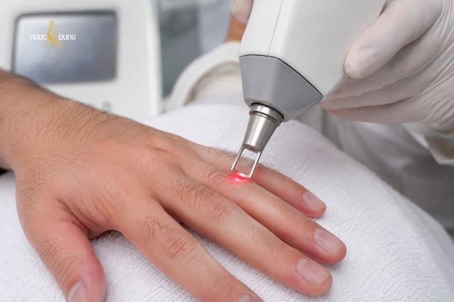 Laser là giải pháp loại bỏ lông ngón tay hiệu quả bền lâu