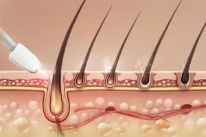 Triệt lông vùng kín có đau không còn phụ thuộc vào cơ địa da của bạn