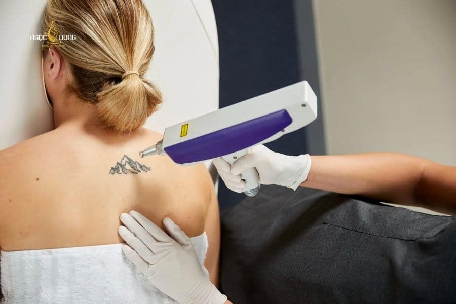Hãy ưu tiên xóa hình xăm bằng laser tại các cơ sở uy tín