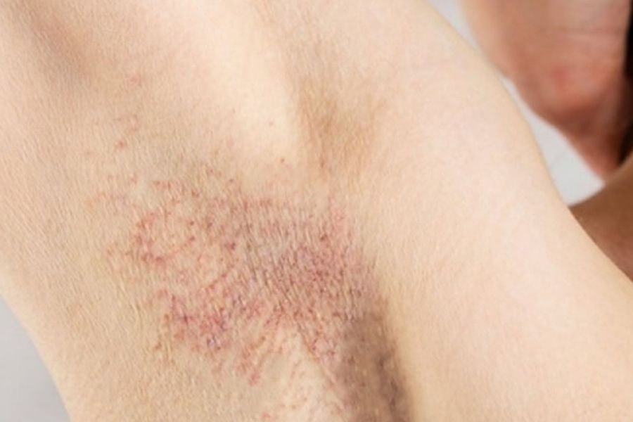 Bị ngứa khi mọc lông nách còn có thể do viêm nang lông gây ra