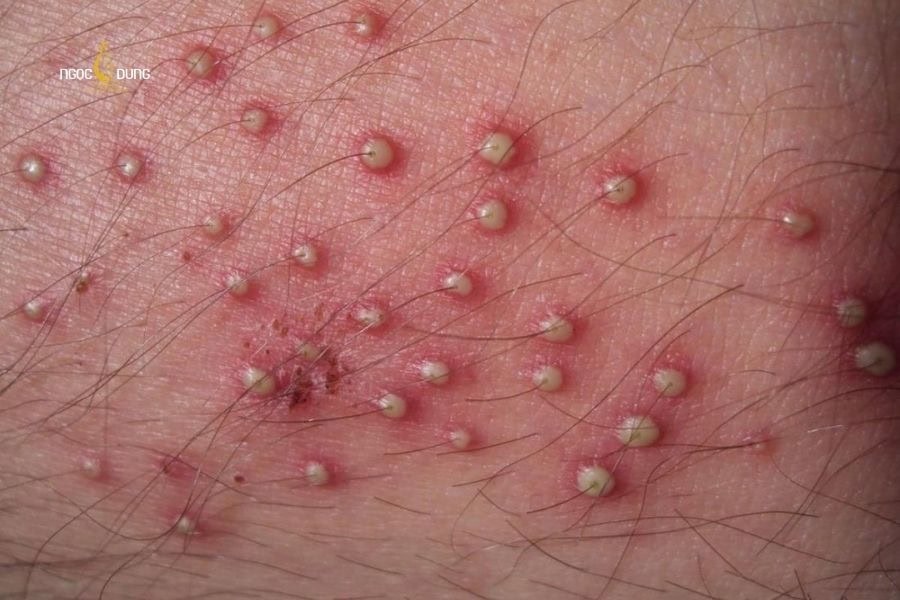 Bị ngứa và nổi mẩn đỏ ở vùng kín nam còn có thể do viêm nang lông gây ra
