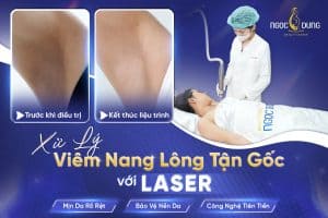 viem nang long moi