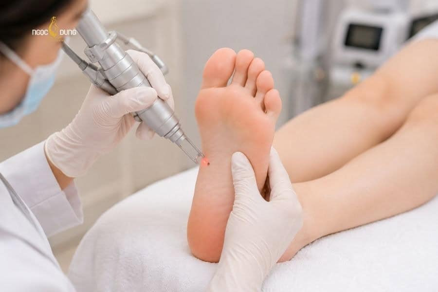 Giải mã ý nghĩa nốt ruồi lòng bàn chân nam nữ: Tốt xấu? 15 Xóa nốt ruồi an toàn và không đau đớn tại Ngọc Dung