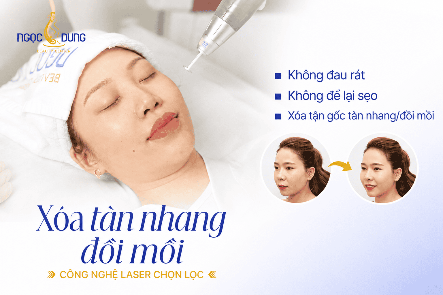 Xóa tàn nhang và đồi mồi