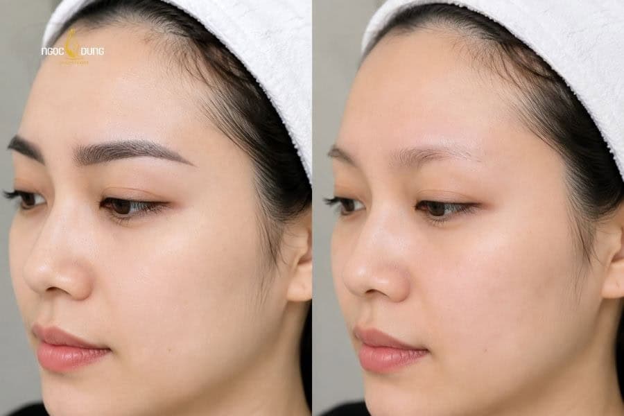 Xóa xăm laser có để lại sẹo không và chi tiết mức giá 5 Xóa xăm cần nhiều buổi thực hiện (tùy theo tình trạng) để đảm bảo đạt kết quả tốt nhất