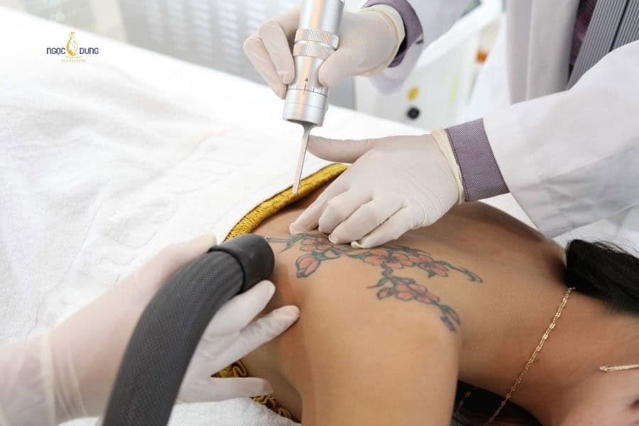 Xóa xăm chuẩn y khoa được thực hiện trong điều kiện vô trùng