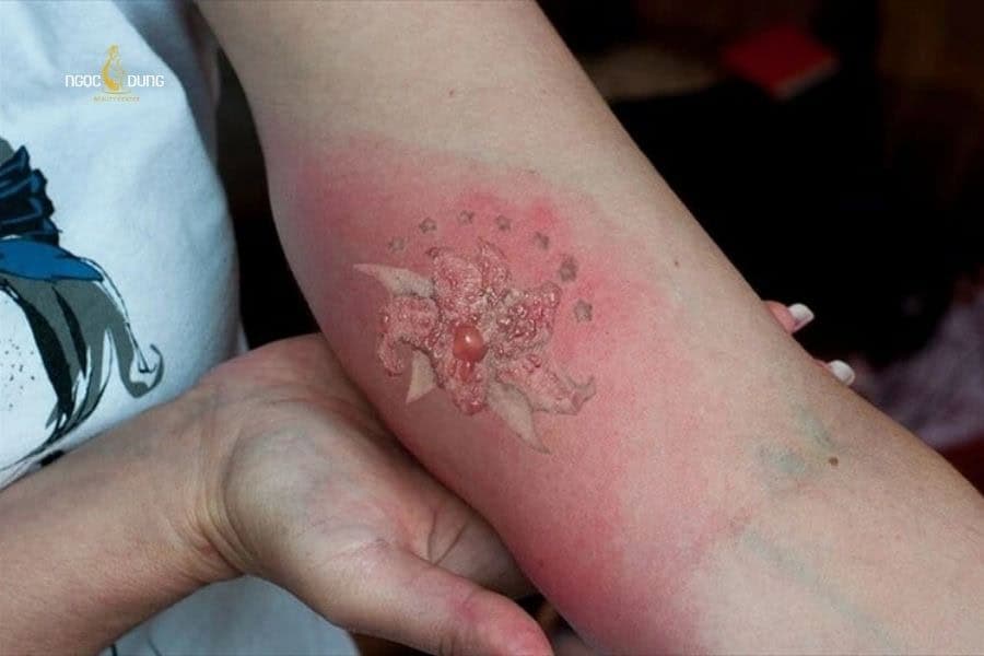 Xóa xăm có thể gây biến chứng nếu thực hiện sai kỹ thuật