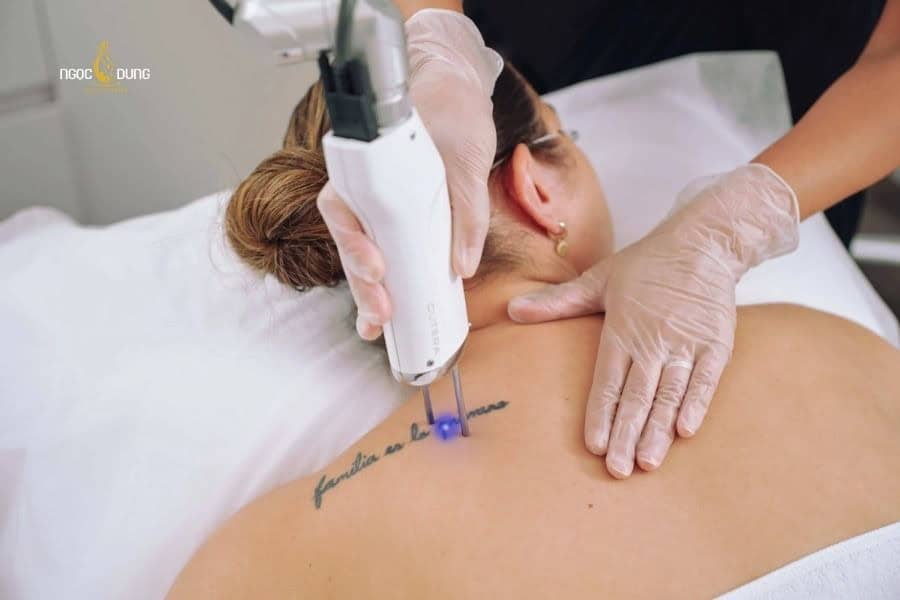 Xóa xăm thường được thực hiện theo mong muốn của người sở hữu