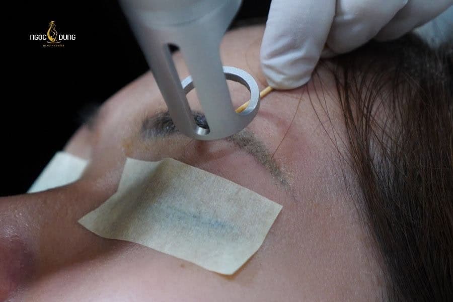 Xóa xăm lông mày tại địa chỉ uy tín sẽ giúp bạn có kết quả đẹp và an toàn hơn