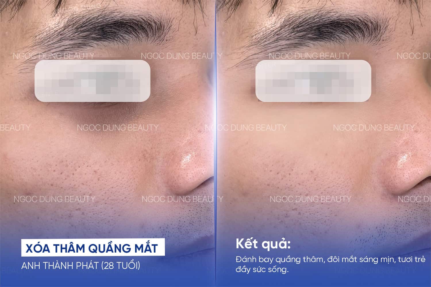 Trị thâm mắt – 3 buổi – Giảm quầng thâm rõ rệt