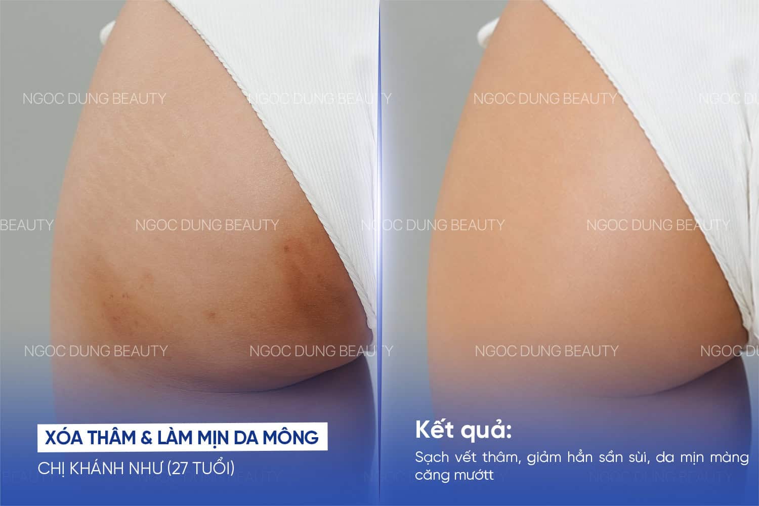 Trị thâm mông – 5 buổi – Đào sáng khỏe mịn màng
