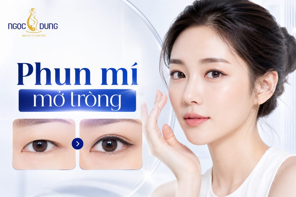 Phun mí mở tròng là gì? Bảng giá, Quy trình và Địa chỉ uy tín