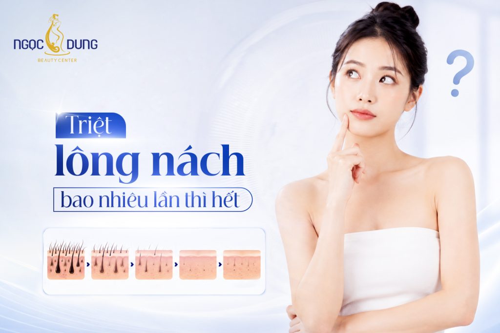Triệt lông nách bao nhiêu lần thì hết? Giải đáp chi tiết