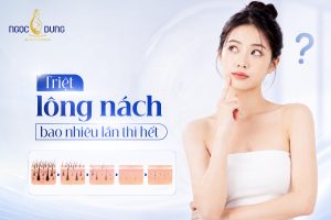 Triệt lông nách bao nhiêu lần thì hết? Giải đáp chi tiết