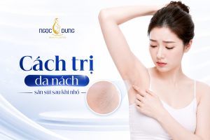 Cách trị da nách sần sùi sau khi nhổ lông hiệu quả nhanh