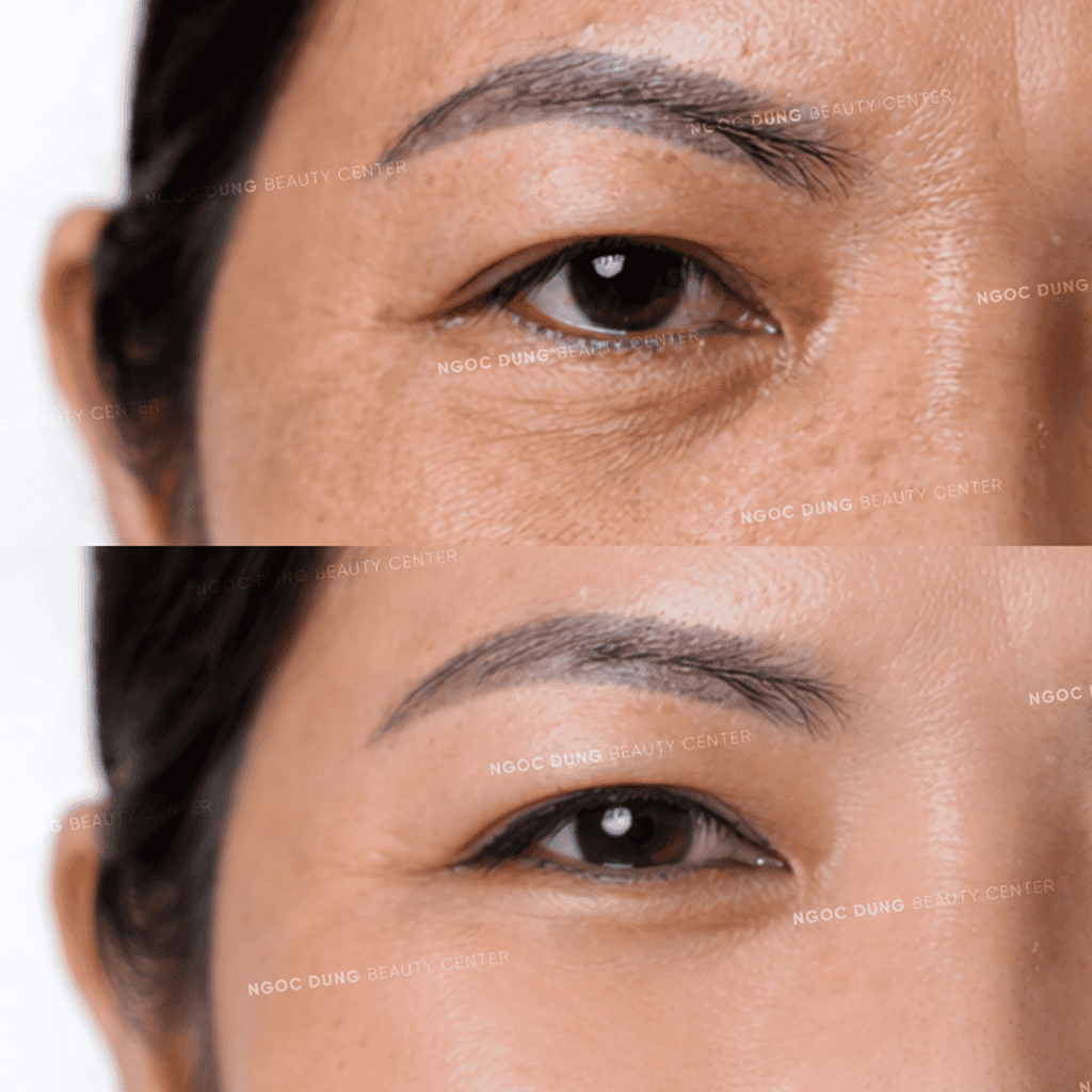 B A 19.3 HIFU MAT 2 1