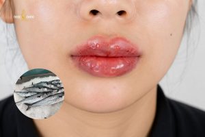 Không nên ăn cá chứa nhiều Histamine nếu vừa phun môi xong vì dễ gây kích ứng