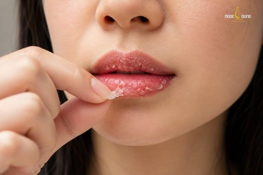 Môi bị thâm loang sau phun: Cách xử lý và nguyên nhân 6 Tự ý bóc vảy môi bong sau phun sẽ dễ làm môi bị thâm và loang màu