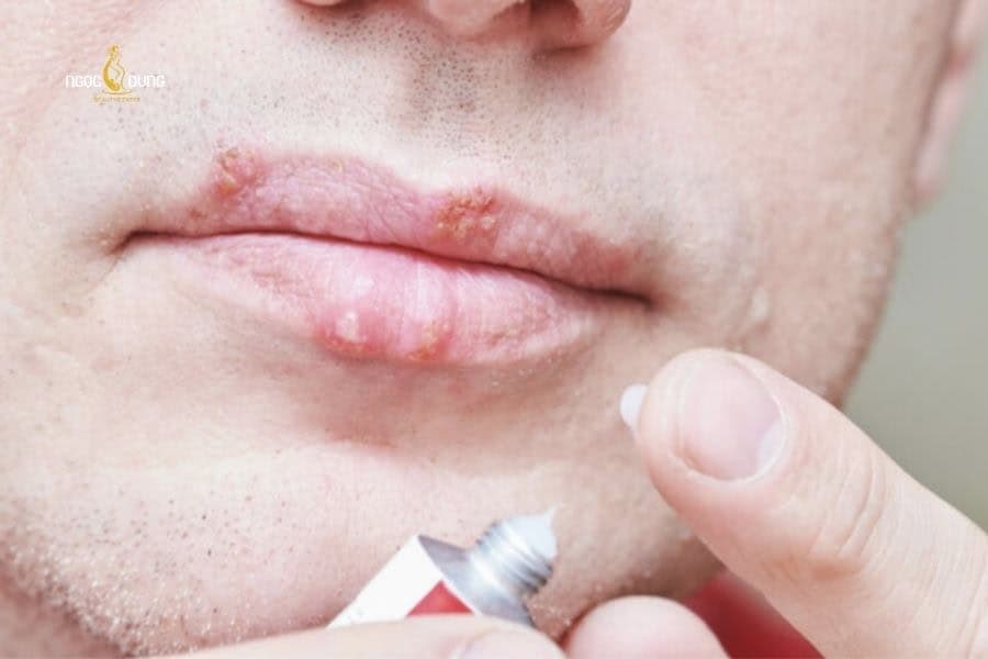 Chỉ bôi acyclovir khi môi xuất hiện dấu hiệu nhiễm virus Herpes