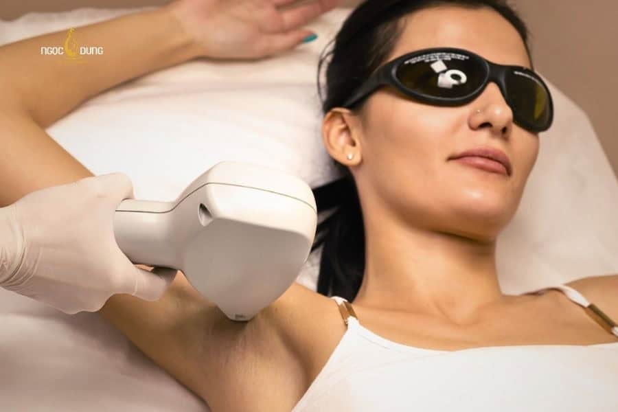 So sánh Diode Laser và DPL: Đâu là công nghệ triệt lông tối ưu nhất? 3 Triệt lông DPL cần nhiều thời gian hơn Laser mới thấy rõ hiệu quả