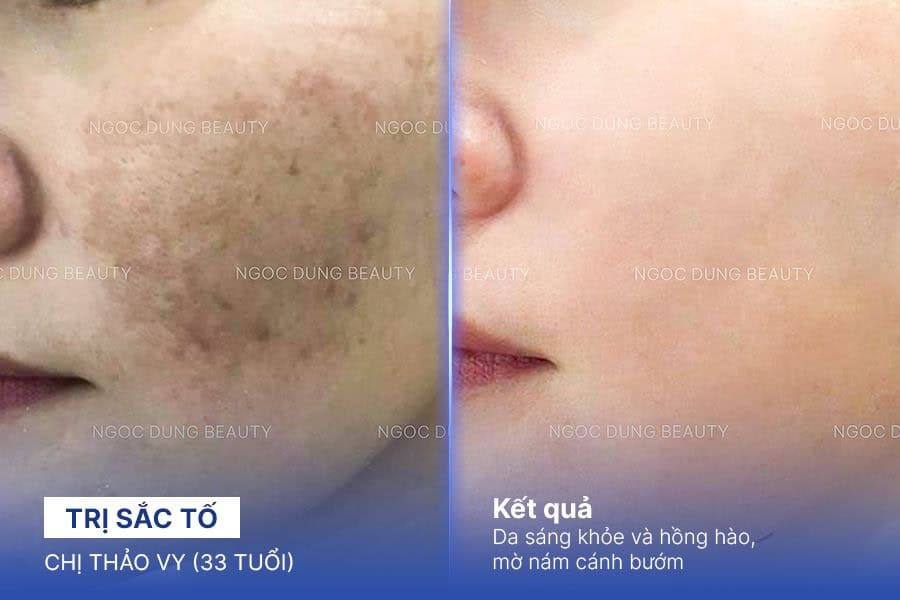 Điều trị sạm da tại TMV Ngọc Dung