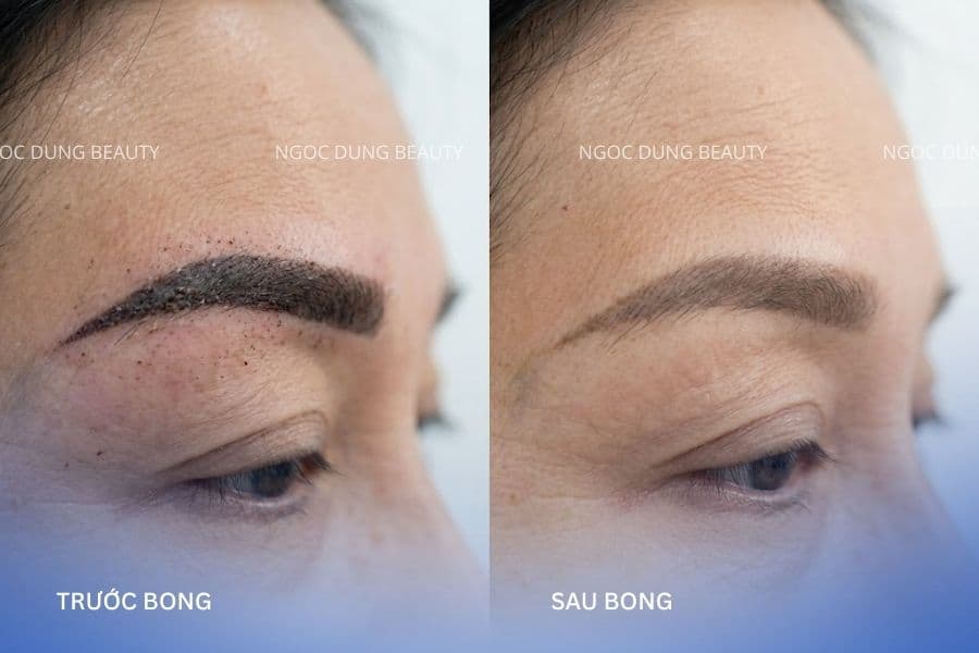 Hình ảnh lông mày trước khi bong và sau khi lớp vảy bong hoàn toàn 