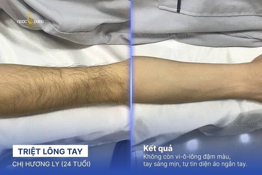 Triệt lông đầu lạnh là gì? Ưu điểm, bảng giá và quy trình 7 Kết quả triệt lông đầu lạnh New Elight tại Ngọc Dung