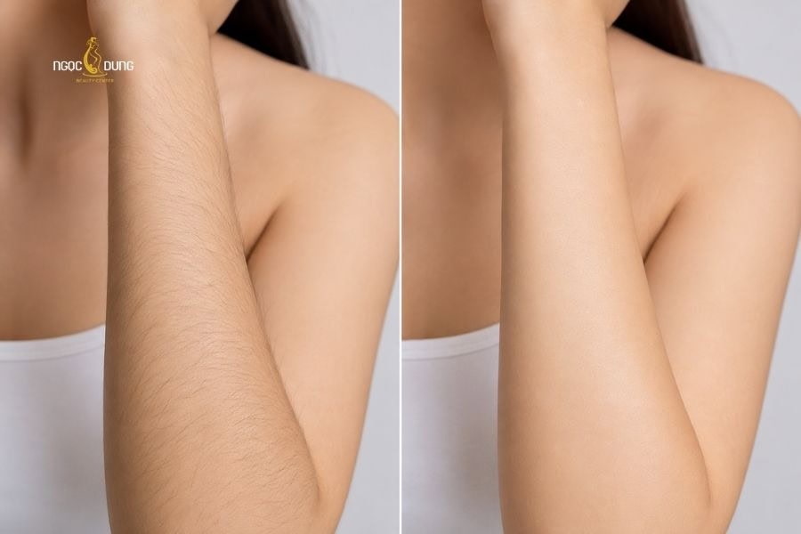 Triệt lông đầu lạnh là gì? Ưu điểm, bảng giá và quy trình 3 Triệt lông đầu lạnh cho kết quả lông chậm mọc bền lâu hơn