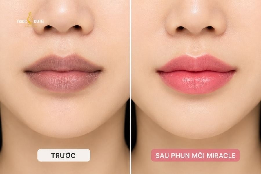Phun môi Miracle có thể khắc phục được tình trạng môi thâm