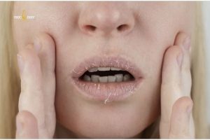 Bóc da môi nhiều có sao không