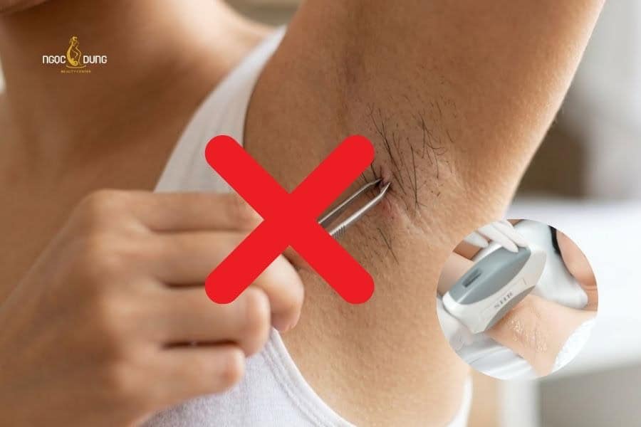 Không nên nhổ lông nách khi đã thực hiện liệu trình triệt lông