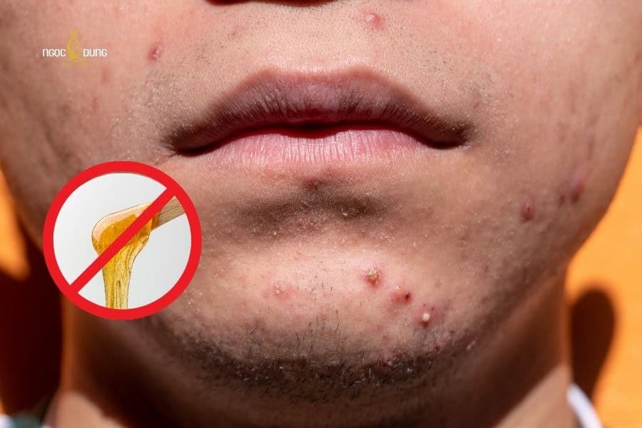 Cách wax râu cho nam tại nhà chuẩn an toàn và không đau 5 Không nên wax râu khi da đang có mụn viêm