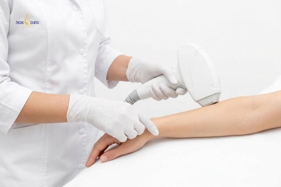 Triệt lông 1/2 cánh tay giá bao nhiêu? Bảng giá chi tiết 5 Nên triệt lông nửa tay theo liệu trình để đạt kết quả tốt nhất