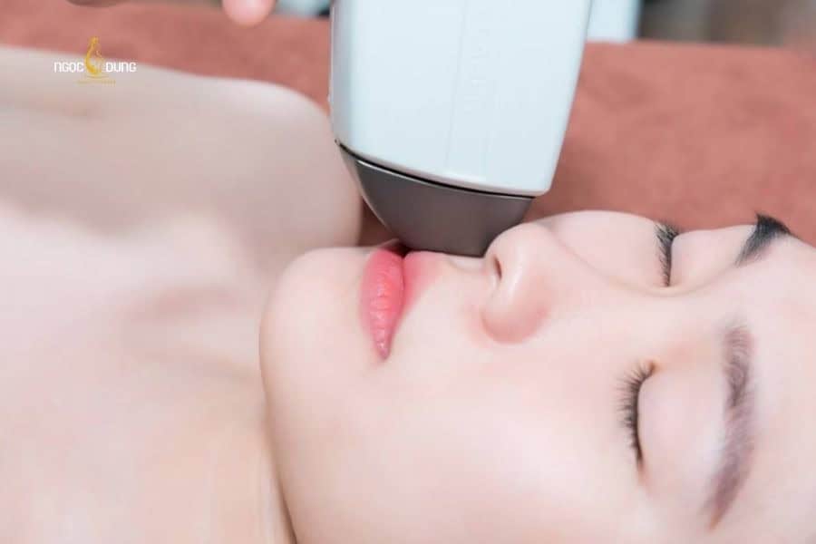 Có nên cạo ria mép tuổi dậy thì không? Cách xử lý an toàn 7 Nên cân nhắc triệt ria mép công nghệ cao để có kết quả lâu dài