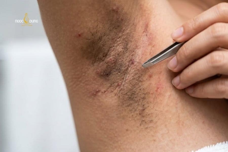 Nhổ lông nách sai cách làm thâm sạm vùng da dưới cánh tay